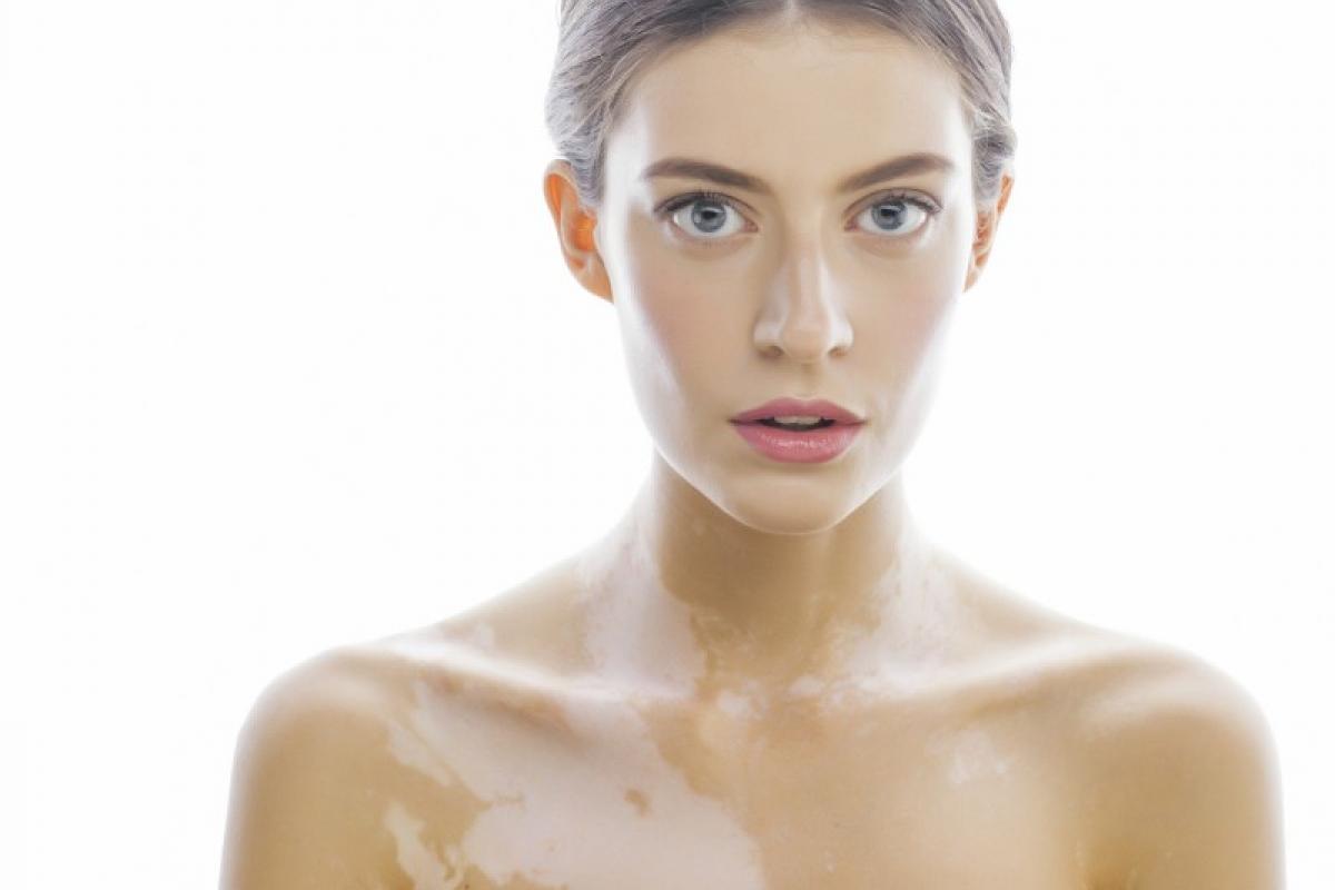 Vitiligo