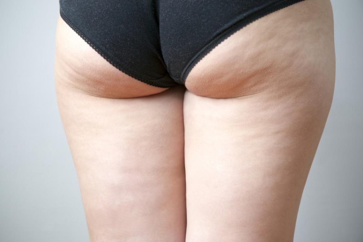 Cellulite